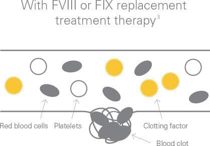 With factor VIII or IX replacement therapy the clotting mechanism can be restored in people with hemophilia A or B respectively.
